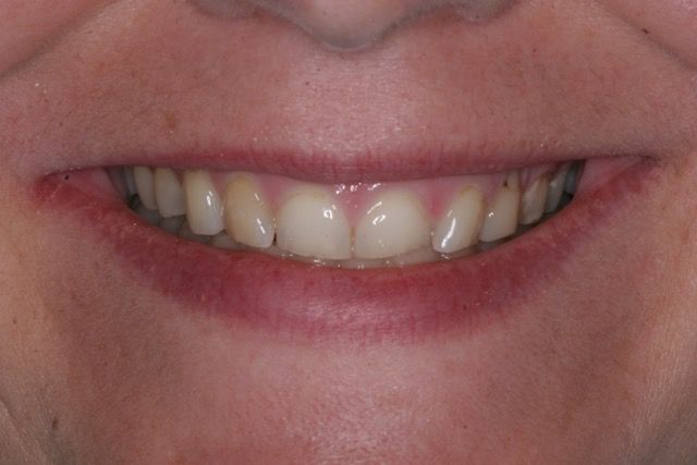 Before veneers and crowns